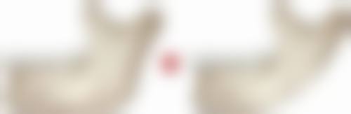 富贵包抽脂后复发概率怎么样