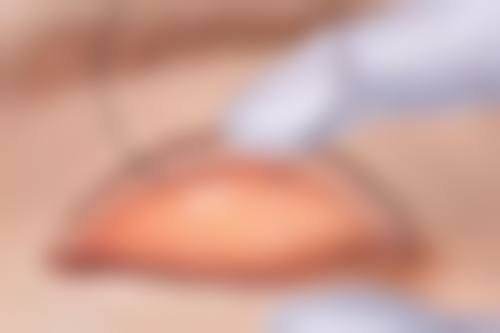 抽脂丰胸对身体有害吗？权威解答：科学操作下危害极小，放心追求完美身材不是梦！ 