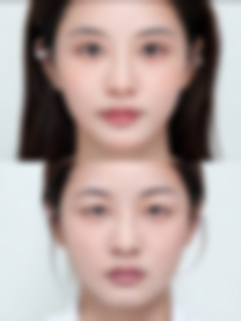 双眼皮手术做完抽烟会增加感染风险吗