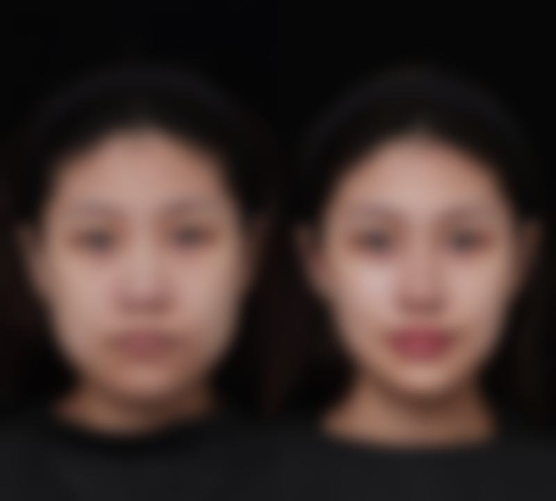 自体软骨隆鼻长期维持的依据是什么