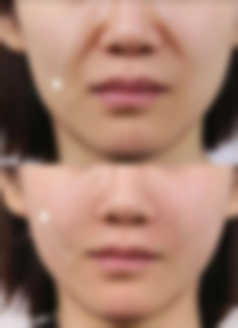 脂肪移植隆胸值得做吗
