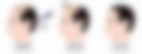 治疗凹陷疤痕选择哪种方法适合自己