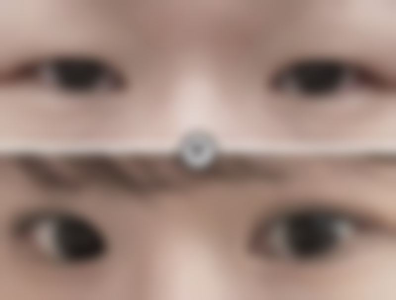 用牙签划出双眼皮和手术割双眼皮相比,坚持时间哪个更短