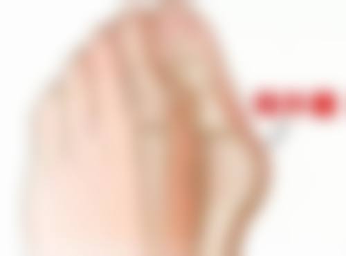 激光祛疤去除胸口疤痕疙瘩适合吗