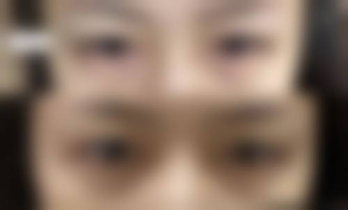 眼部水肿造成双眼皮变单眼皮怎么快速修复