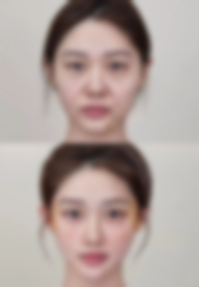 睡眠姿势不当使双眼皮变单眼皮如何调整