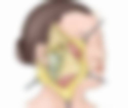 激光祛疤治疗手术疤痕增生靠谱吗