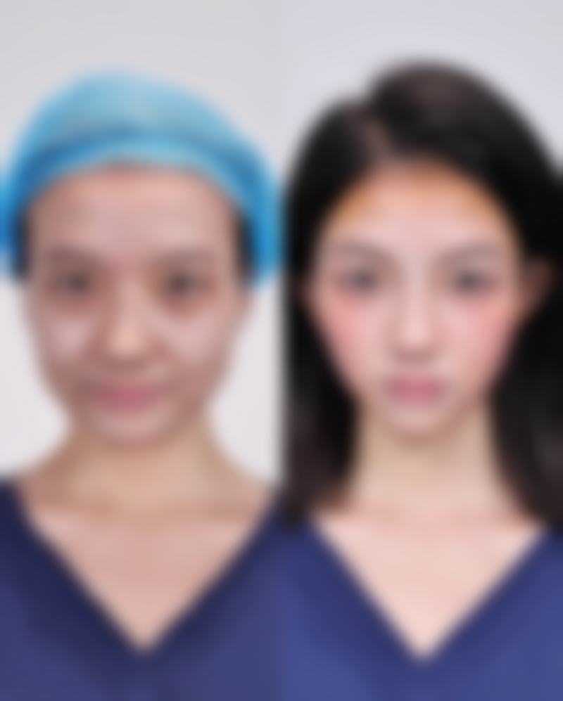 打瘦脸针后化妆需要注意什么