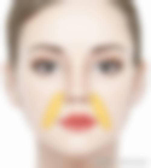 覃方燕做双眼皮适合哪些人群?