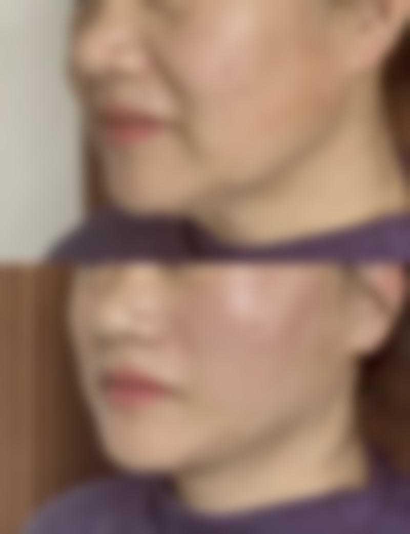 内切去眼袋术消除天生下眼袋后如何护理