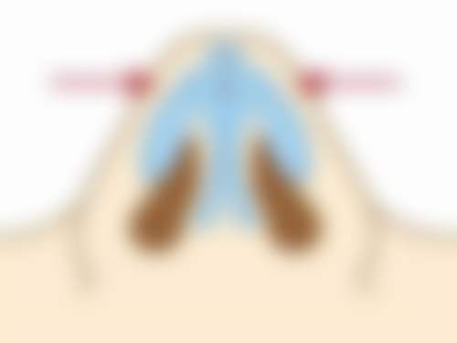 下颌角整形手术术后成效保护秘诀靠谱吗