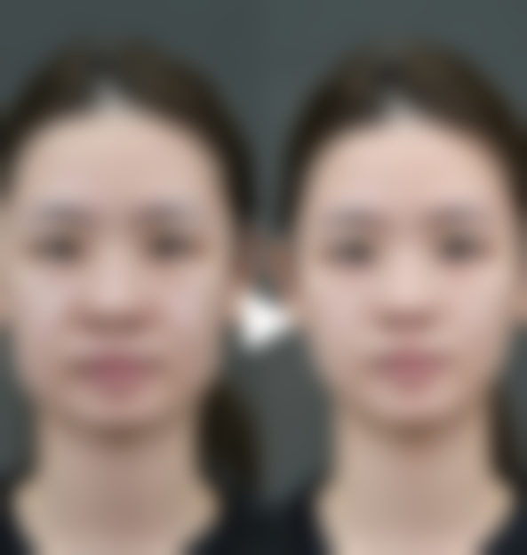 手术方式如何影响肋骨隆鼻定型时间