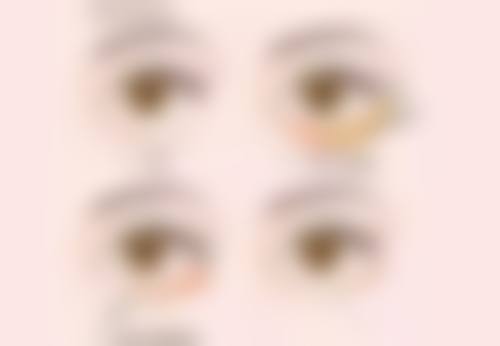 祛痣后疤痕修复期间需要注意什么?