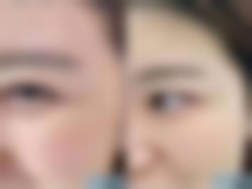 微晶磨皮去除脸上疤痕靠谱吗