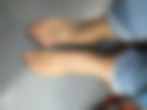 3D双眼皮手术的成效能维持多久