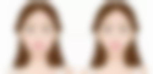 做完双眼皮眼睛和眉毛更近了怎么办？别慌！专业医美医生教你通过眼部修复手术轻松改善这一状况！ 