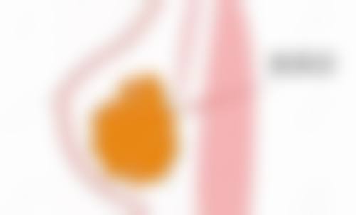 激光治疗疤痕增生能重塑肌肤平滑吗