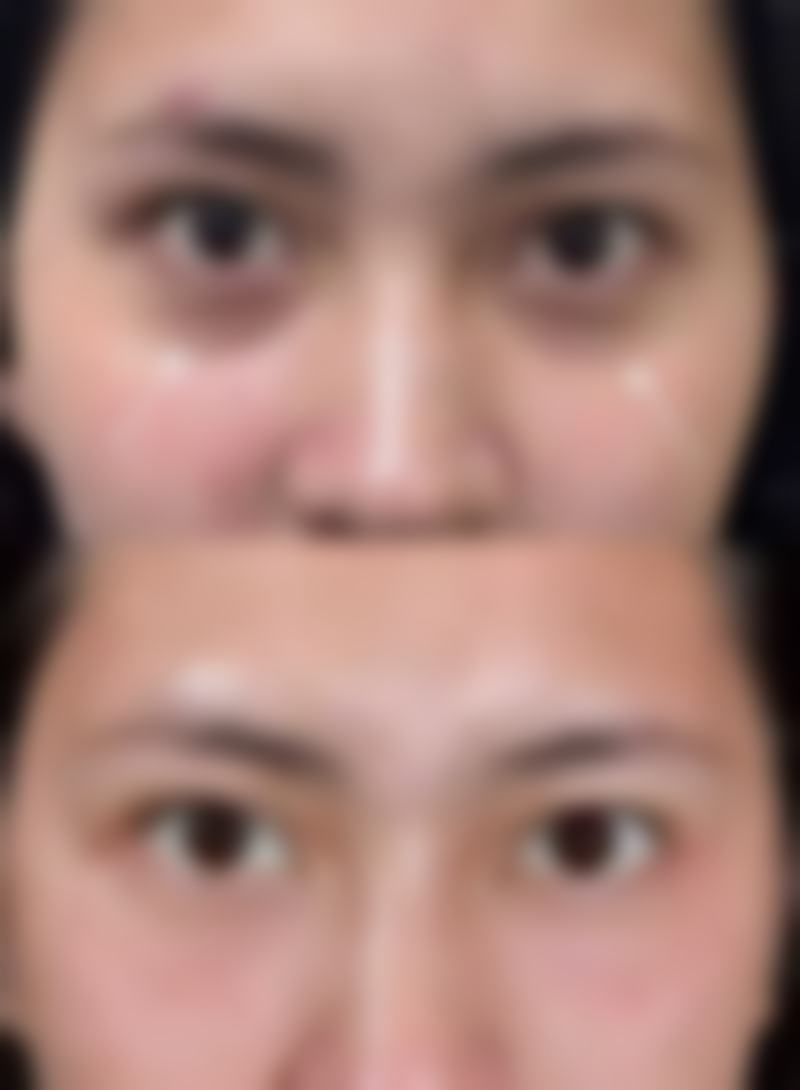 激光治疗疤痕增生值不值