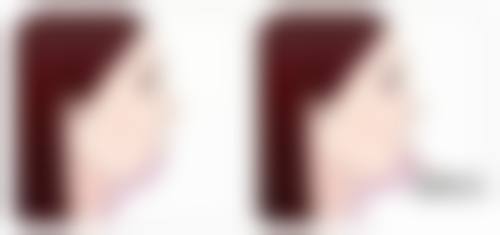 除了内切去眼袋还有其他去眼袋方法吗