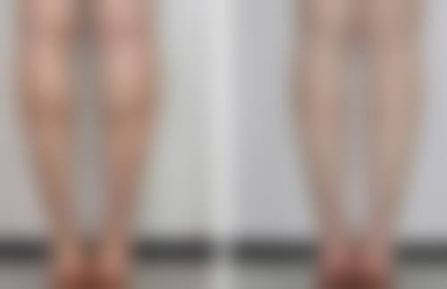 割双眼皮加开眼角 1 - 3 个月初步修复怎么样