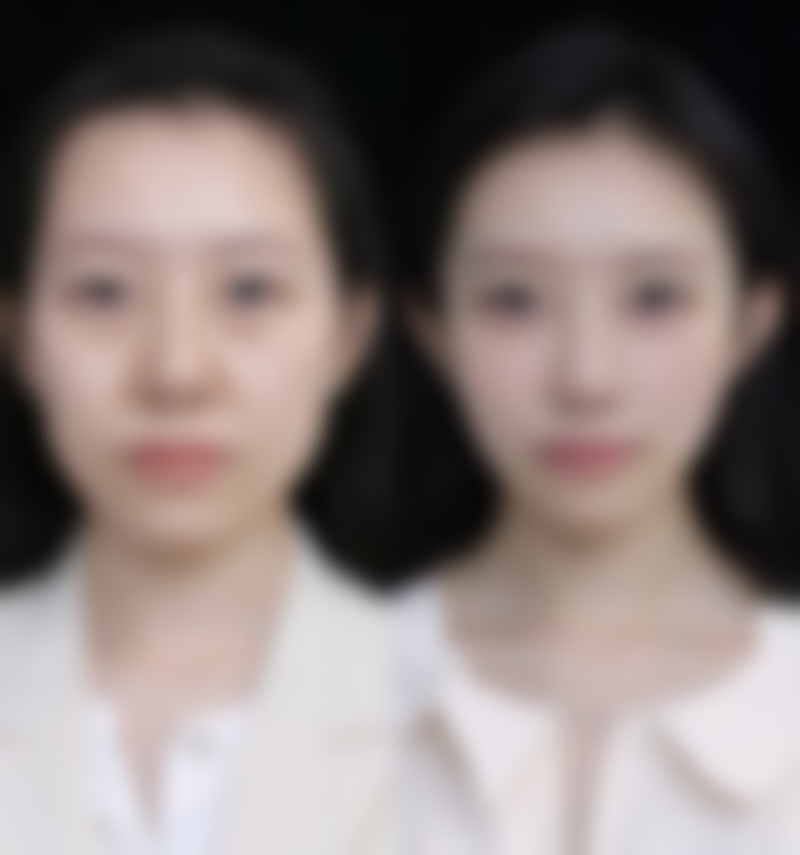 做完眼袋泪沟填充后定期复查重要吗?