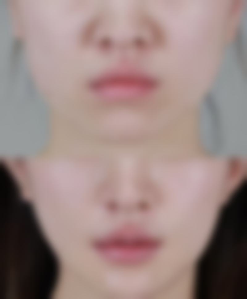 做完眼袋泪沟填充后伤口护理怎么样?