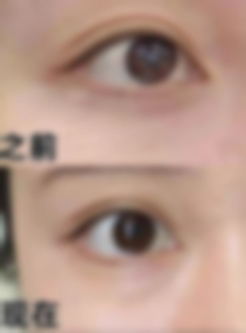 做完眼袋泪沟填充后多久能化妆?