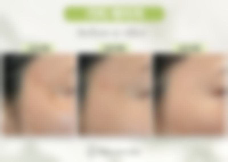 SCUlPTRA童颜针价格约5000元起