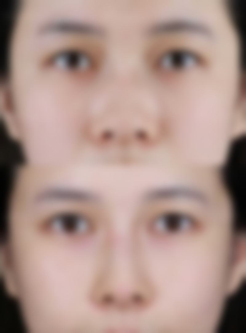 薛志峰技术特色与刘氏传奇美眼术解析