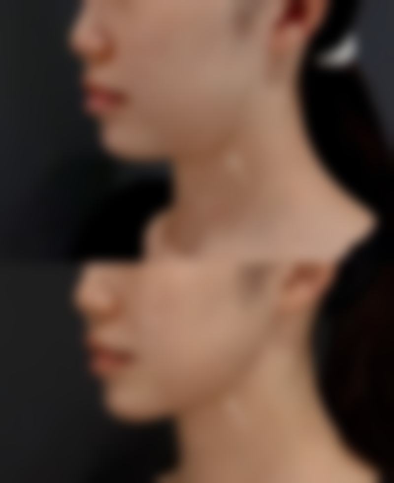 2026双眼皮吊顶怎么选?自然妈生款更耐看,搭配眼型更精致,容貌飙升不踩雷