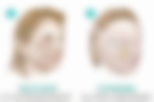 卢建伟苹果肌提升价格体系与技术解析