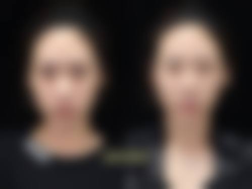 超声 刀治疗的优势与局限性分析