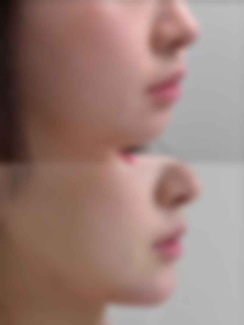 眼尾上扬双眼皮手术的优势、风险及术后护理指南
