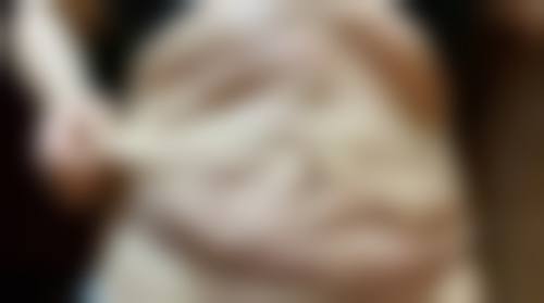 2026埋线双眼皮后常睁眼能加速定型?揭秘消肿变得更美小秘诀