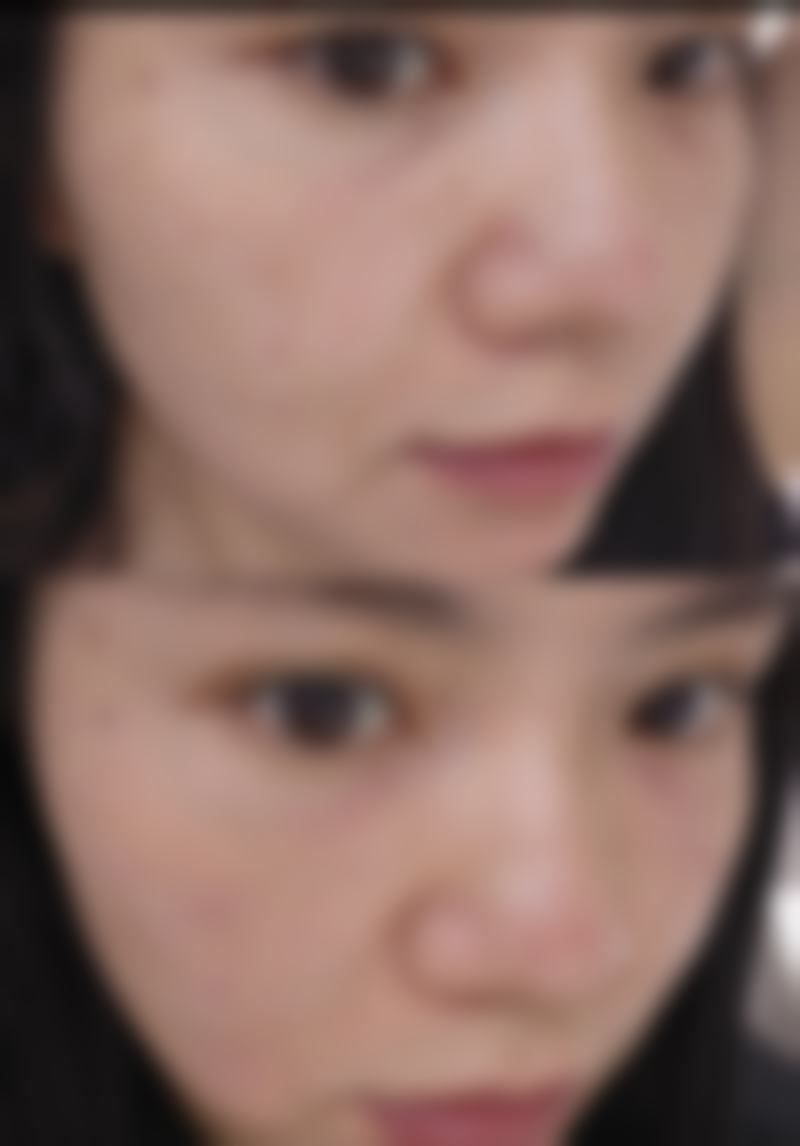 豆豆眼双眼皮手术的风险规避与术后护理终极攻略