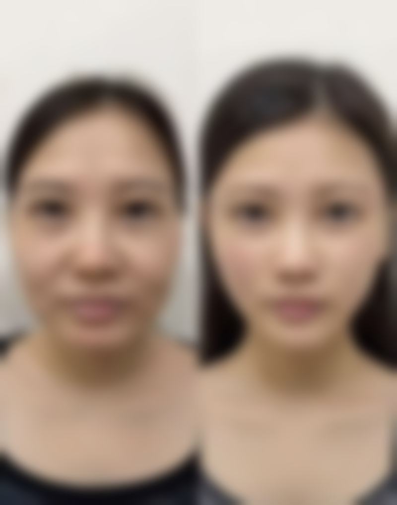 耳软骨融合不排异,超体稳固易取出,亲测反馈:选对材料真能一直美!