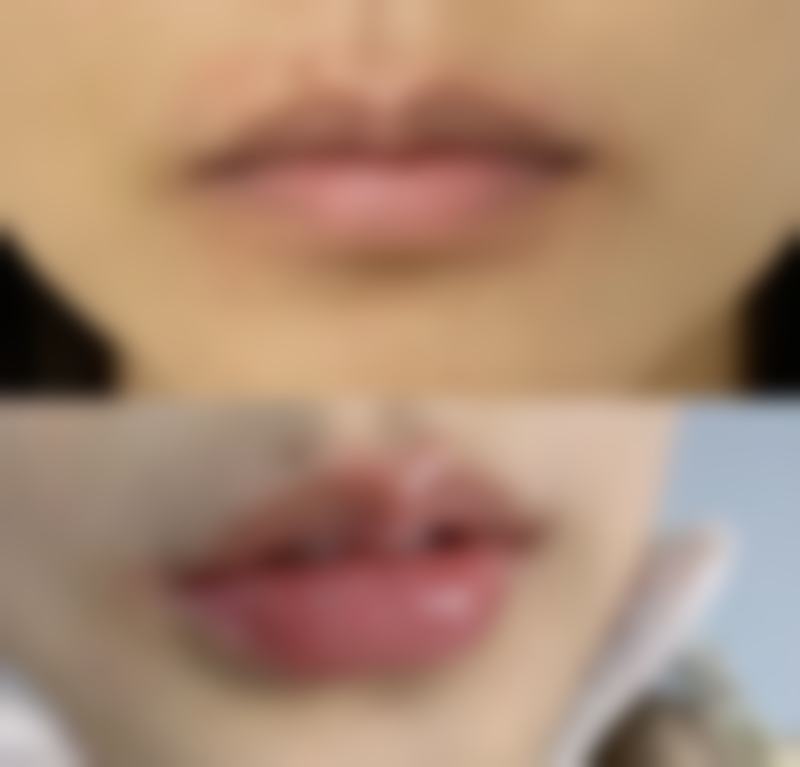 总结:豆豆眼双眼皮,理性选择成就美丽未来