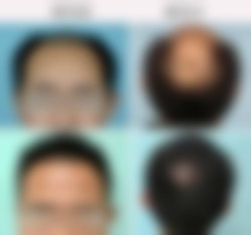 呼和浩特宜兴医院植发预约流程与就医体验